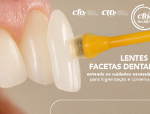Lentes e facetas dentais: entenda os cuidados necessários para higienização e conservação
